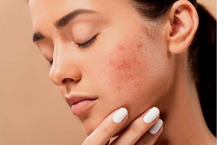 Les remèdes à utiliser pour se débarrasser de l’acné 